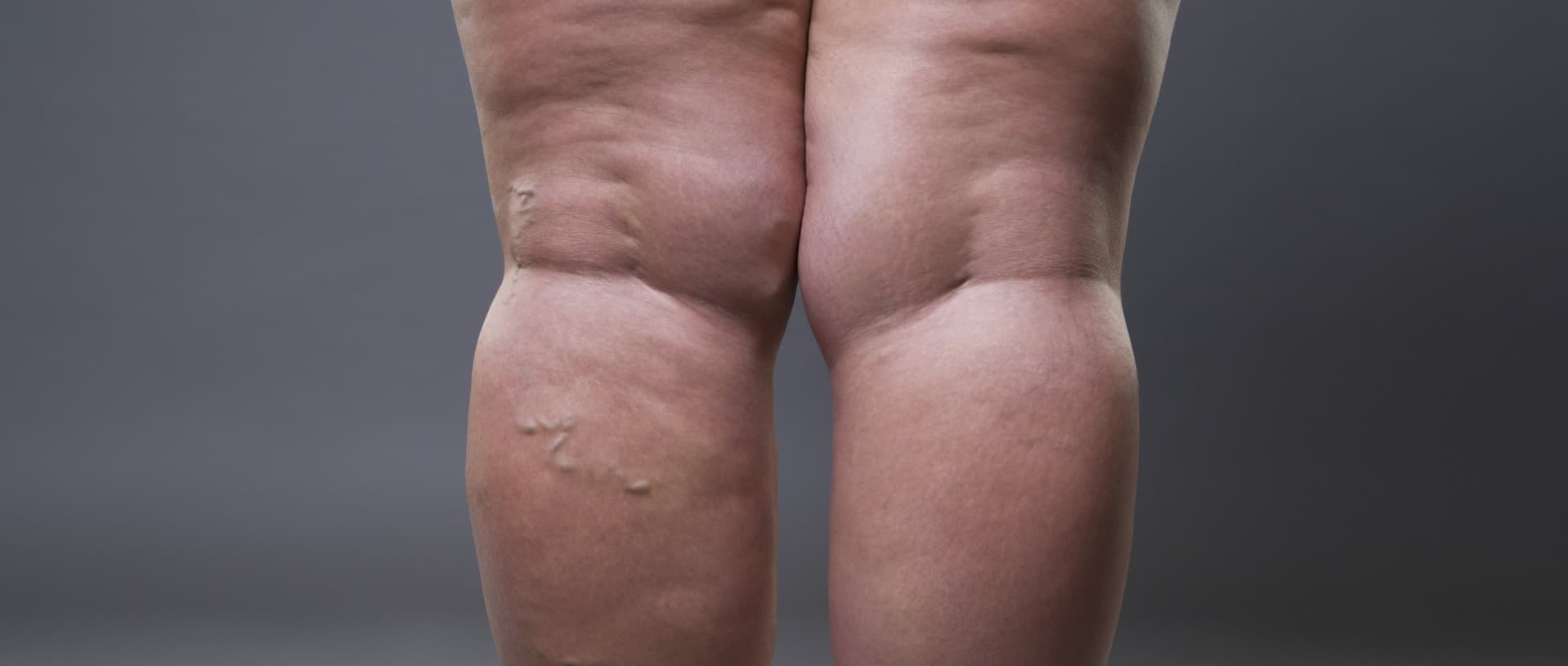 Anzeichen Lipödem: Wann helfen Kompressionstherapie &amp; Lymphdrainage?