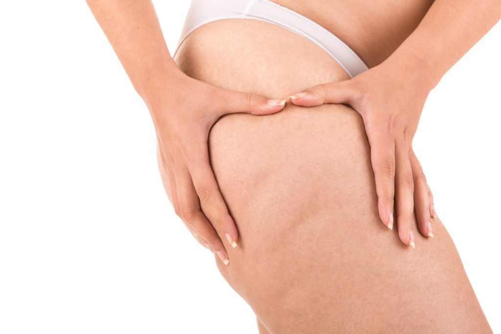 Anzeichen Lipödem: Wann helfen Kompressionstherapie &amp; Lymphdrainage?