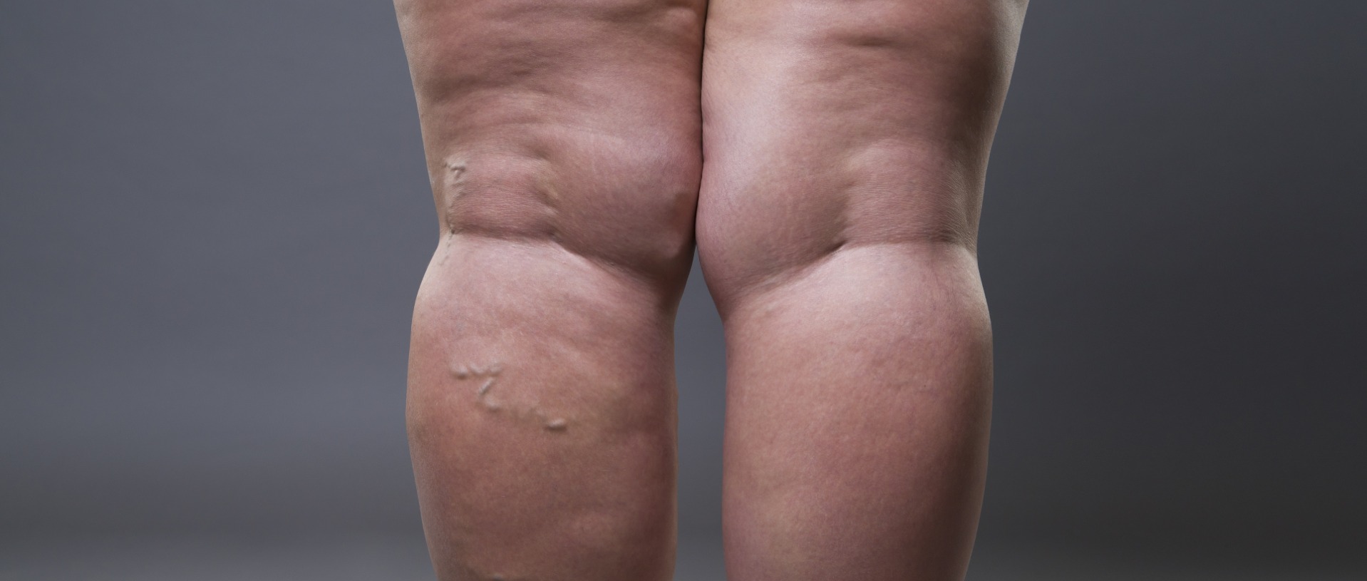Anzeichen Lipödem: Wann helfen Kompressionstherapie &amp; Lymphdrainage?
